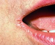 Mine are very much like this. Very subtle and small, but very much there. A tiny crack on the side of the mouth.